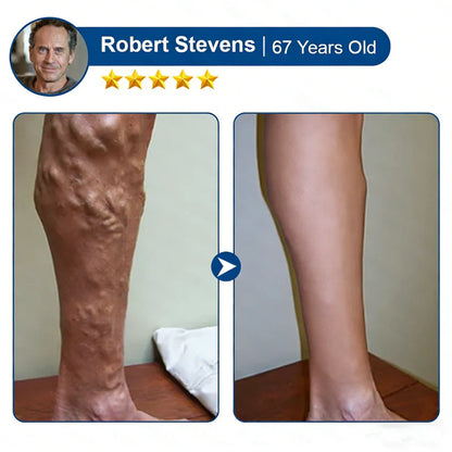 Cougex® 𝑽𝗲𝗶𝙣 𝘾𝐨𝐧𝘁𝗼𝙪𝙧 𝙈𝙞𝐜𝐫𝒐𝒏𝒆𝗲𝗱𝗹𝙚 𝙋𝙖𝐭𝐜𝒉 𝒘𝒊𝘁𝗵 𝗔𝙙𝙫𝙖𝙣𝙘𝐞𝐝 𝐃𝒊𝒐𝒔𝗺𝙞𝐧 & 𝑯𝒆𝘀𝗽𝗲𝙧𝙞𝙙𝙞𝐧 𝐃𝒆𝒍𝒊𝒗𝗲𝗿𝙮🌿𝟕-𝐃𝐚𝐲 𝐕𝐢𝐬𝐢𝐛𝐥𝐞 𝐑𝐞𝐬𝐮𝐥𝐭𝐬 𝐟𝐨𝐫 𝐕𝐚𝐫𝐢𝐜𝐨𝐬𝐞 𝐕𝐞𝐢𝐧𝐬