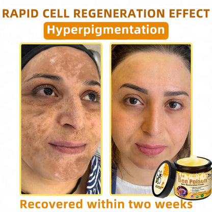 QIAWI™ 🐝Bee Poison Skin Restoration Cream 🐝（🔥LAST DAY SALE-80% OFF)🥇👩‍⚕️