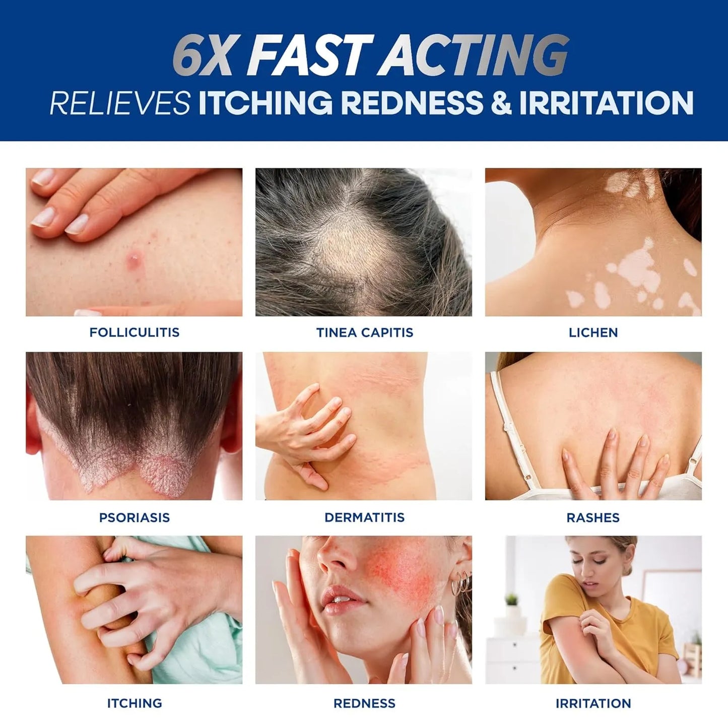 Folliculitis Treatment Cream: Effective Treatment for Folliculitis Scalp Face and Body 100g