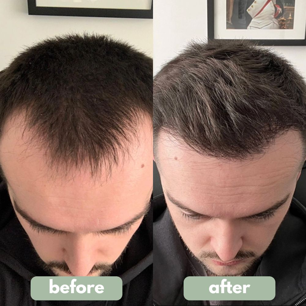 BBOJI™ Hair Growth Serum