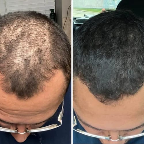 BBOJI™ Hair Growth Serum