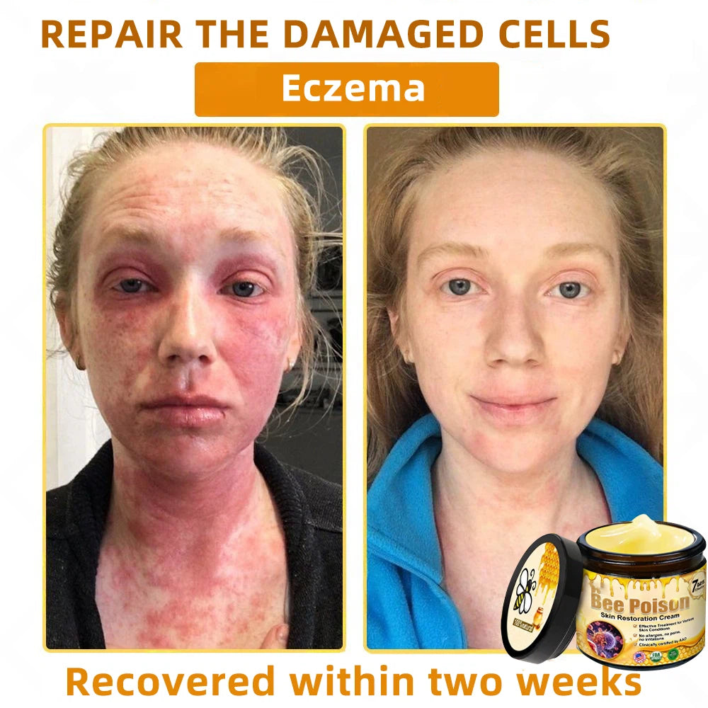 QIAWI™ 🐝Bee Poison Skin Restoration Cream 🐝（🔥LAST DAY SALE-80% OFF)🥇👩‍⚕️