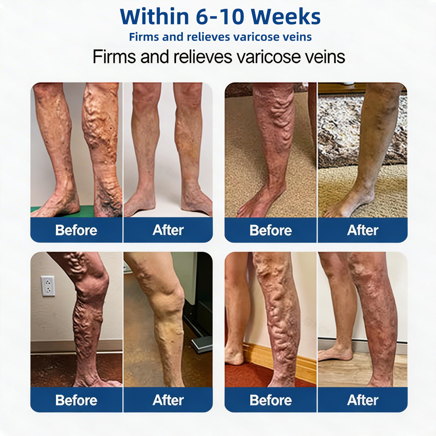 𝑽𝗲𝗶𝙣 𝘾𝐨𝐧𝘁𝗼𝙪𝙧 𝙈𝙞𝐜𝐫𝒐𝒏𝒆𝗲𝗱𝗹𝙚 𝙋𝙖𝐭𝐜𝒉 𝒘𝒊𝘁𝗵 𝗔𝙙𝙫𝙖𝙣𝙘𝐞𝐝 𝐃𝒊𝒐𝒔𝗺𝙞𝐧 & 𝑯𝒆𝘀𝗽𝗲𝙧𝙞𝙙𝙞𝐧 𝐃𝒆𝒍𝒊𝒗𝗲𝗿𝙮🌿𝟕-𝐃𝐚𝐲 𝐕𝐢𝐬𝐢𝐛𝐥𝐞 𝐑𝐞𝐬𝐮𝐥𝐭𝐬 𝐟𝐨𝐫 𝐕𝐚𝐫𝐢𝐜𝐨𝐬𝐞 𝐕𝐞𝐢𝐧𝐬
