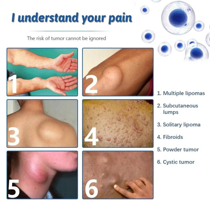 LIPOMA REMOVAL SPRAY (IMPORTED)