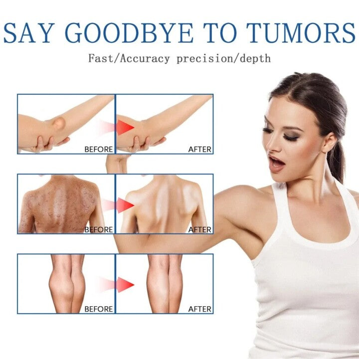 LIPOMA REMOVAL SPRAY (IMPORTED)